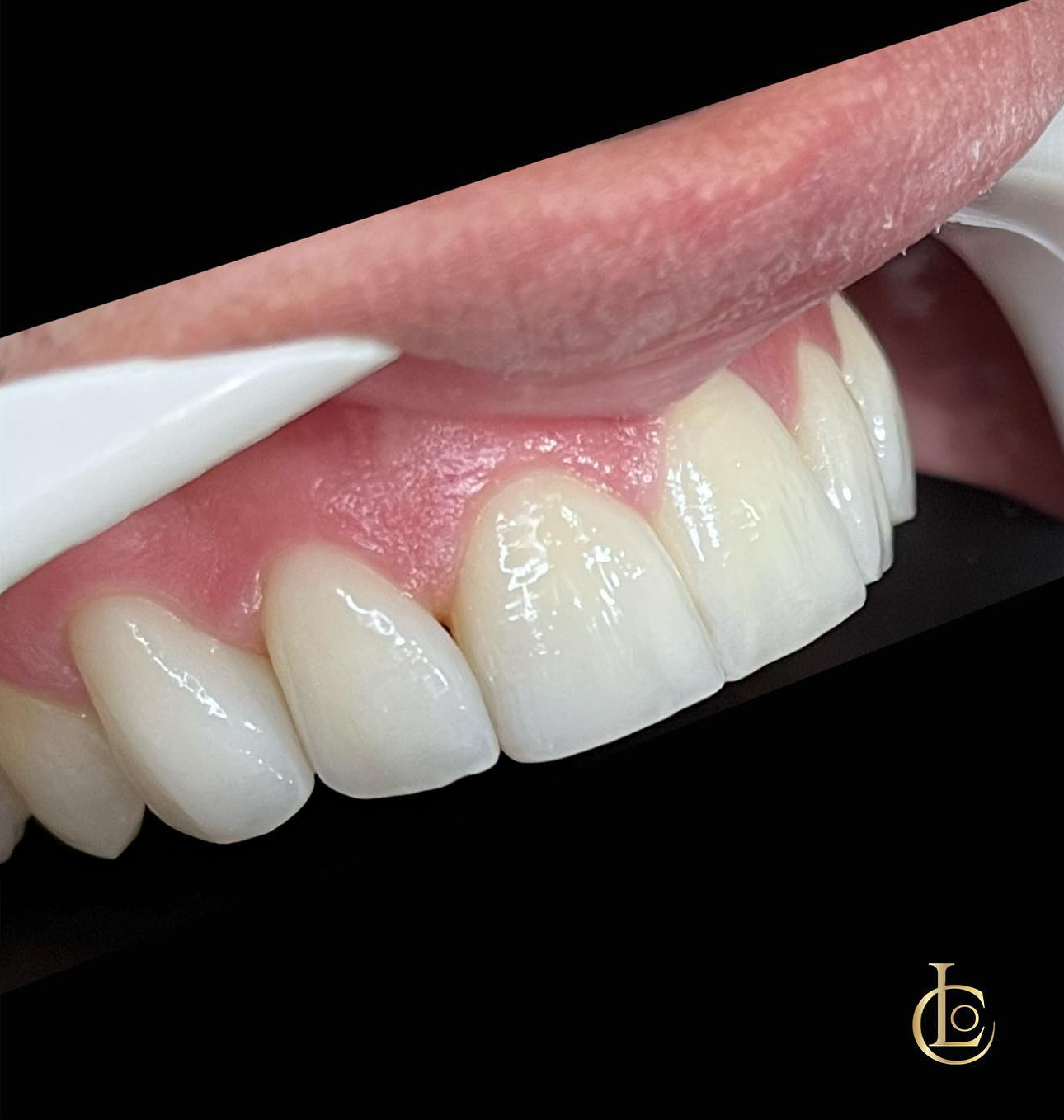 Restaurações e reabilitação